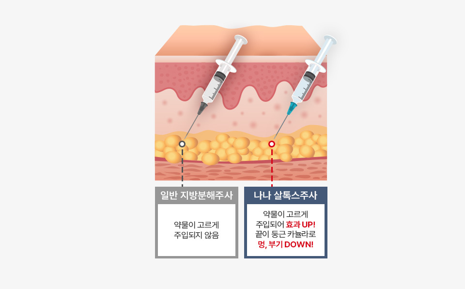 지방분해주사 나나만의 지방분해방식
