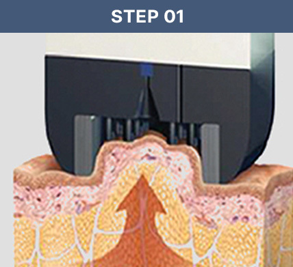 인모드 STEP 01