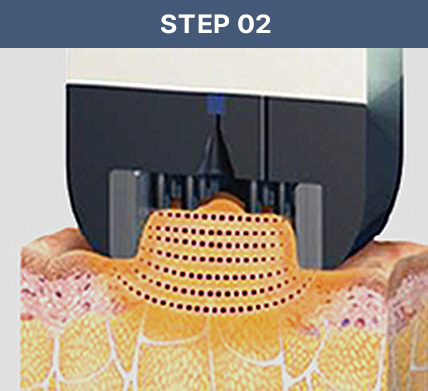 인모드 STEP 02