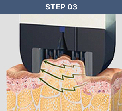 인모드 STEP 03