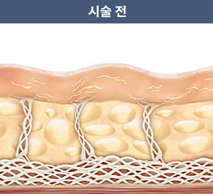 울쎄라피 프라임 시술 전