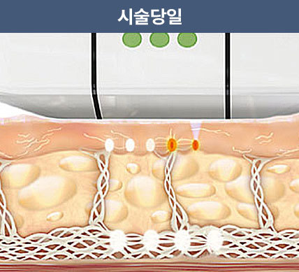 울쎄라피 프라임 시술 당일