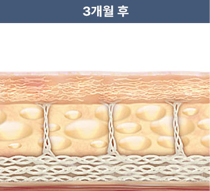 울쎄라피 프라임 시술 3개월 후