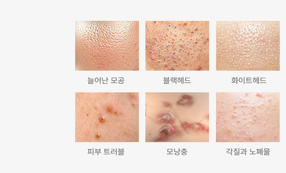 아쿠아필 3단계로 피부고민 해결