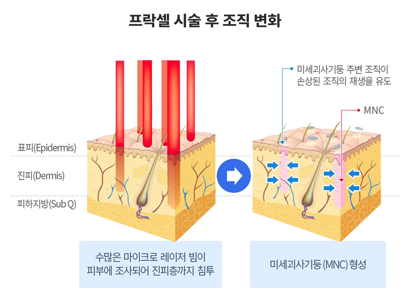 프락셀 시술 후 조직 변화